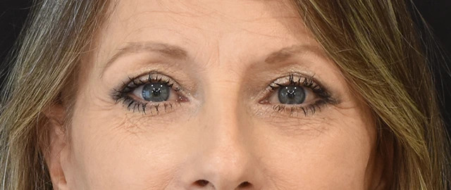 Eyelid Surgery Patient 22 Set 1 After