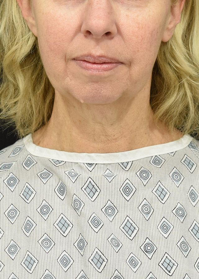 Deep Plane Facelift Patient 18 - Set 1 - Before